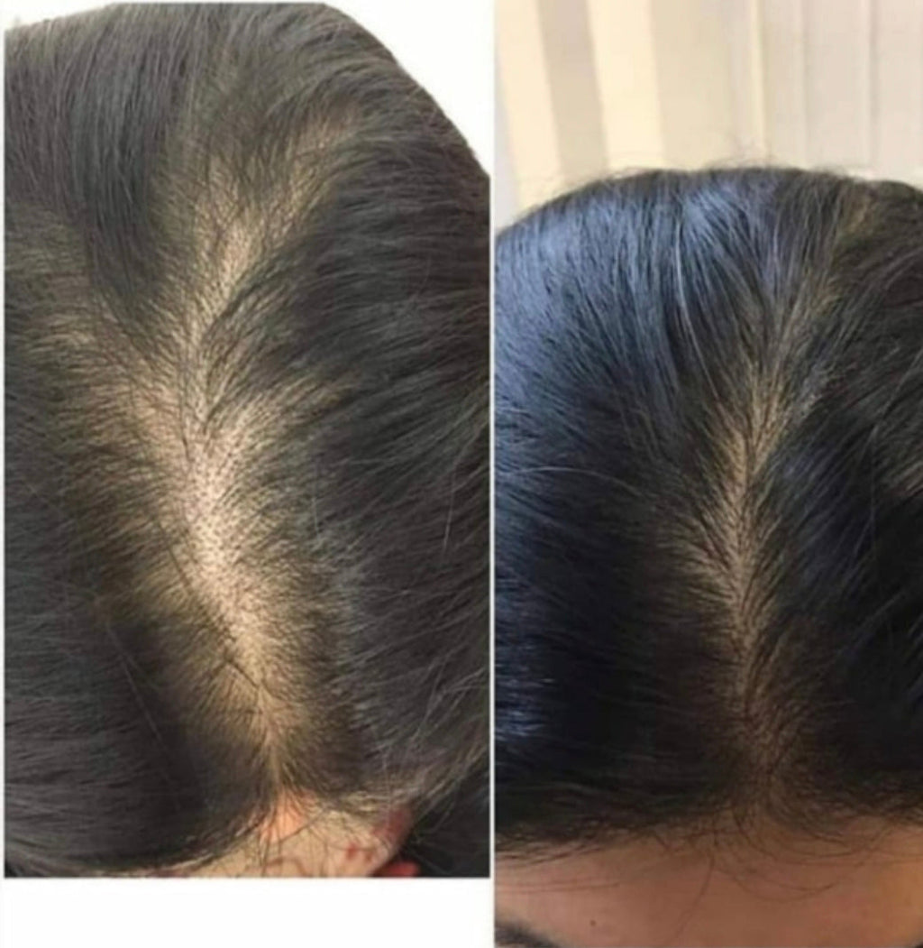 Na: volledige haargroei op de kruin
